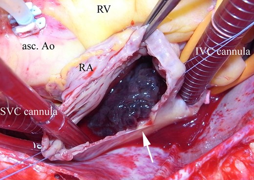 Gross appearance of the right atiral tumor. The right atrial tumor was gelatinous and irregular shaped with a multipapillary surface (arrow). asc. Ao, ascending aorta; RA, right atrium; RV, right ventricle; SVC, superior vena cava; IVC, inferior vena cava.