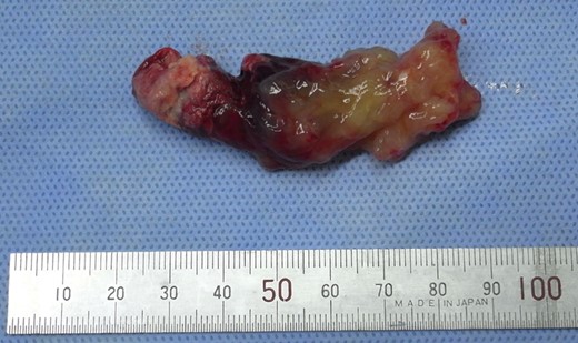 Gross appearance of the pulmonary tumor embolus. The size of the embolus was 64 × 20 mm. Although most of the embolus was soft and gelatinous, it was partly organized and solid.