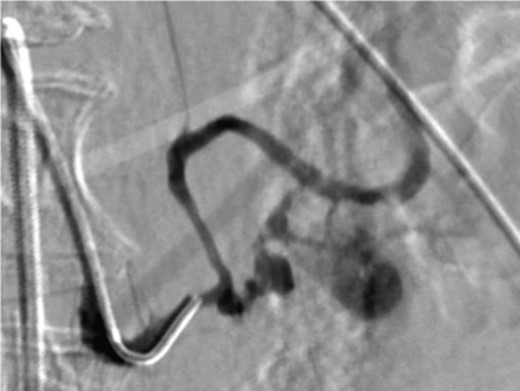 Angiography image showing splenic artery pseudoaneurysm.