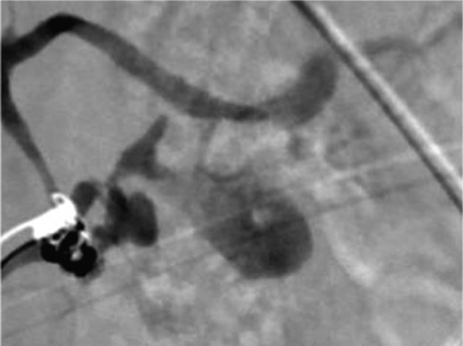 Angiography image showing splenic artery pseudoaneurysm with contrast extravasation.