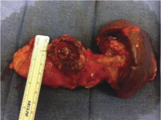 Surgical specimen of en bloc partial gastrectomy, distal pancreatectomy and splenectomy.