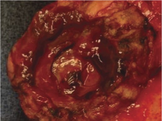 Surgical specimen of en bloc partial gastrectomy, distal pancreatectomy and splenectomy. Embolic coils visible in arterial lumen.