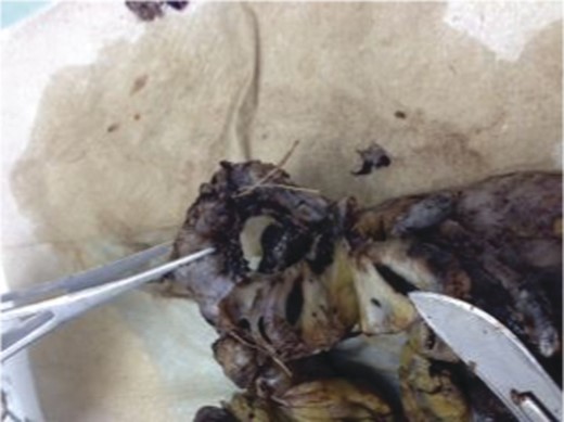 Pathologic specimen–Gastro–splenic artery fistula. Normal caliber splenic artery.