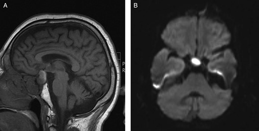 (A) Preoperative sagittal T1-weighted MRI showing a predominantly isointense lesion in the pituitary fossa with some high signal posteriorly. (B) Preoperative axial diffusion-weighted MRI demonstrating a hyperintense lesion in the pituitary fossa.