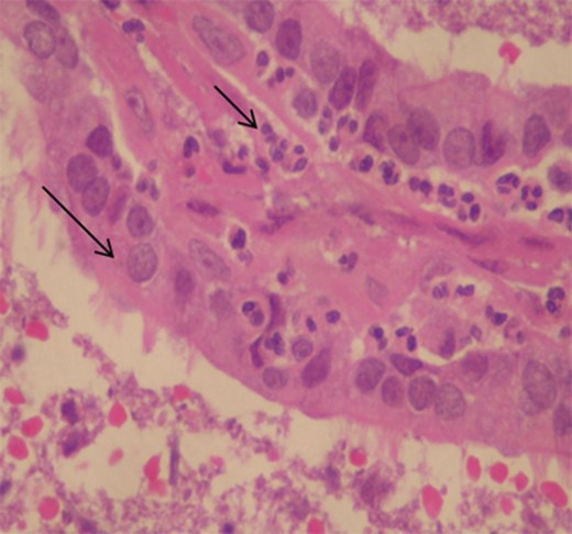 Histological image illustrating the cyst wall composed of ciliated columnar epithelium characteristic of RCC lying on a thin layer of fibrous tissue (long arrow) with infiltration by numerous neutrophils (small arrow; haemotoxylin and eosin original magnification Ă—400).