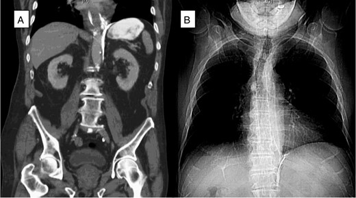(A) A CT scan of the abdomen (coronal plane) demonstrated extraluminal contrast extending around the esophagus and around the left crus of the diaphragm. (B) Chest X-ray after esophagogastroduodenoscopy (EGD) and esophageal stent placement with stent in good position.