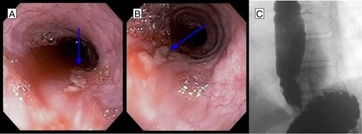 (A, B) EGD after stent removal revealed small healing lacerations in the area of previous perforation. (C) Follow-up esophagram without evidence of leak of contrast.