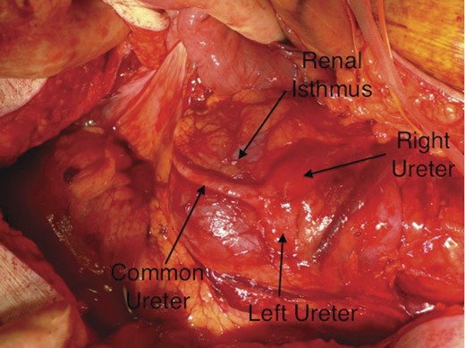 The left and right ureters running over the renal isthmus and fusing to form a common ureter.