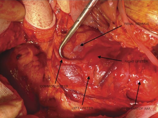 The upper part of the aortic aneurysm, the left and right ureters running over the renal isthmus and fusing to form a common ureter (been pushed by the surgical instrument).