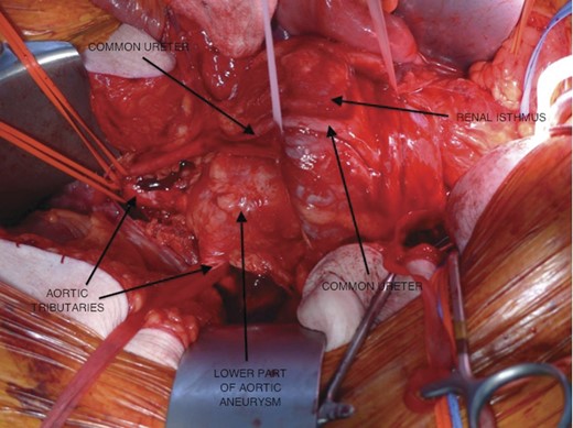 The lower part of the aortic aneurysm with some tributaries from the aorta, the left and right ureters running over the renal isthmus and fusing to form a common ureter.