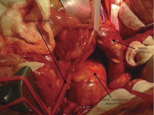 The renal isthmus been pulled up to expose the aneurysm with the common ureter running into the pelvis.