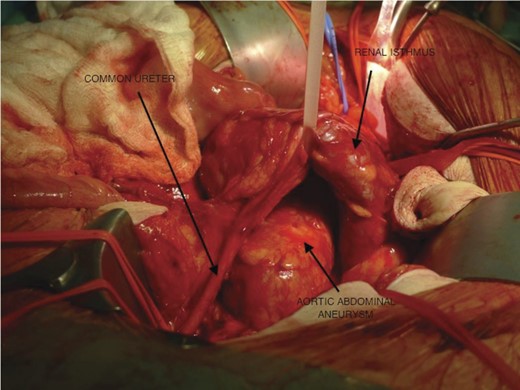 The renal isthmus been pulled up to expose the aneurysm with the common ureter deviated to the right side on its way to the pelvis.