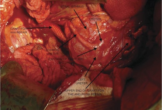 The lower part of the aorta with a graft inserted into the aorta, sticking out slightly above the renal isthmus; the left and right ureters running over the renal isthmus and fusing at a junction to form a common ureter.