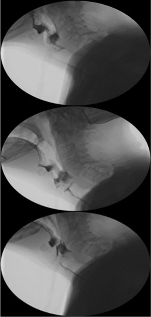 Sequence of barium swallow examinations revealing upper oesophageal tightening and aspiration.