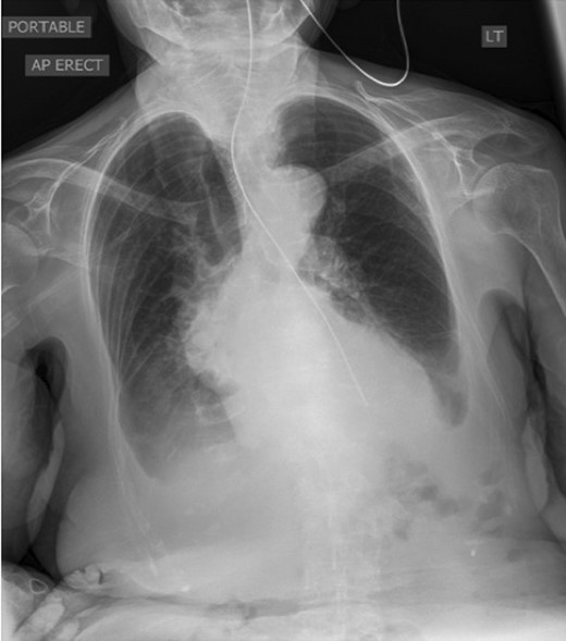 Chest X-ray showing the NG tube blocked at the distal oesophagus. The typical retrocardiac gas filled viscus cannot be seen.
