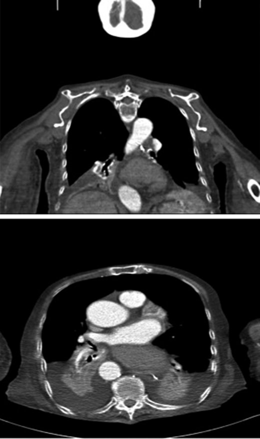 CT thorax sagittal and coronal views revealed an organoaxial volvulus with the stomach occupying the thoracic cavity. White spot indicating the NG tube tip unable to pass through the volvulus.