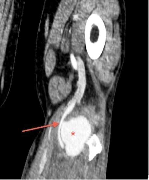 CT angiogram of the left leg, coronal section, shows popliteal pseudoaneurysm (asterisk), communicating and displacing the popliteal artery (arrow).