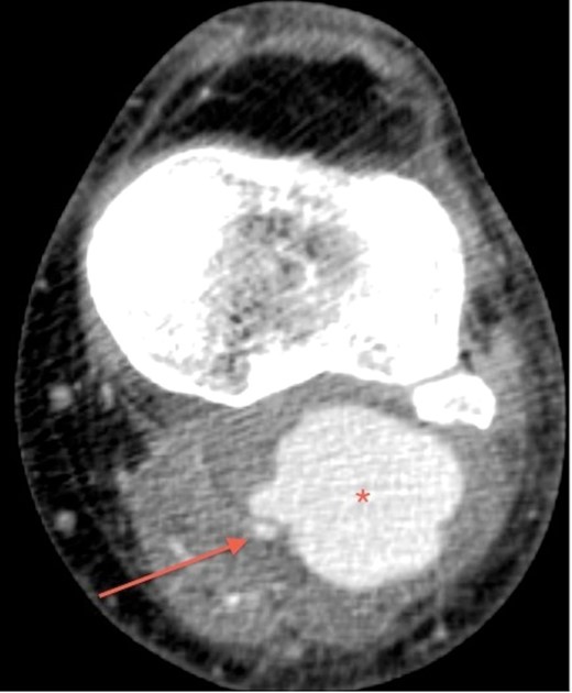 CT angiogram of the left leg, transverse section, shows popliteal pseudoaneurysm (asterisk) adjacent to the popliteal artery (arrow).