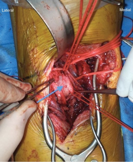Intraoperative finding of popliteal pseudoaneurysm.