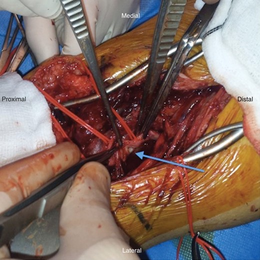 Arteriotomy, after evacuating pseudoaneurysm.