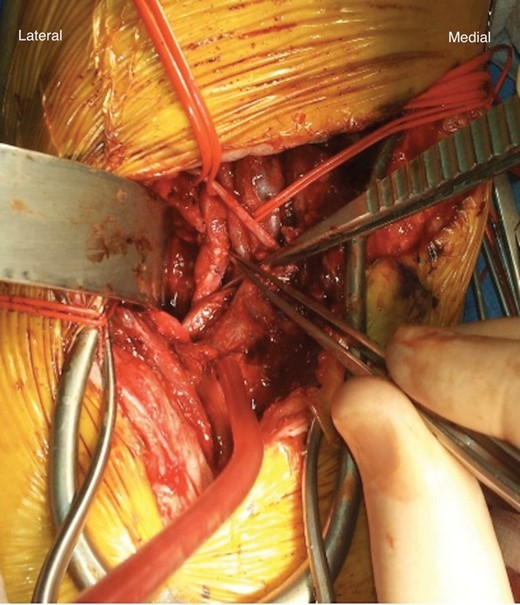 Venous patchplasty performed.