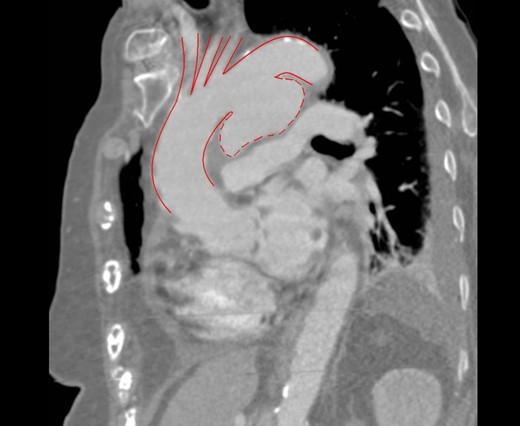 CT scan of the thorax demonstrating large mycotic aneurysm.
