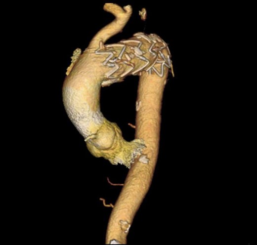 3D reconstructed CT scan showing the endovascular aortic arch repair.