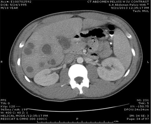 Multiple lucencies noted within the liver consistent with abscesses along with a thickened gallbladder.