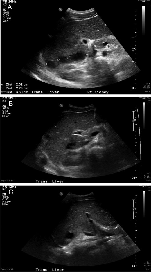 (A) Ultrasonography following initial drainage showing several residual abscesses within the liver, but decreased in number compared with prior exam. (B and C) Ultrasound demonstrating interval improvement in the multiple liver abscesses, with the majority becoming smaller in size and some demonstrating complete resolution.