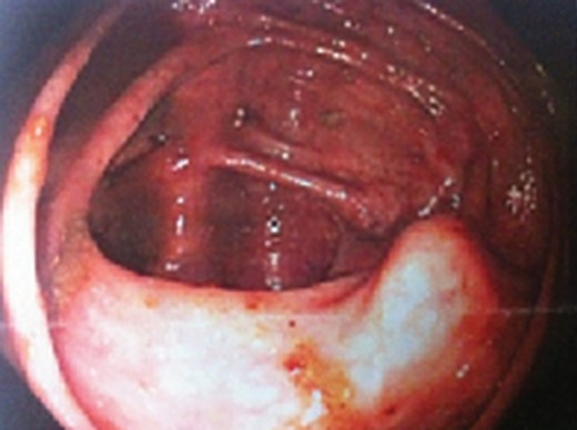 Colonoscopy: view of the cecum; a broad-based mass is present in the right lower corner of the photo. The mucosa appears normal and did not exhibit erythema or ulcerations.