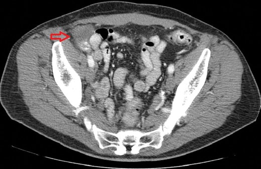 CT scan of the abdomen with intravenous and oral contrast demonstrating a mass in the right lower quadrant adjacent to the cecum.