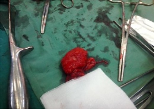 Wedge-excised fistulous segment.