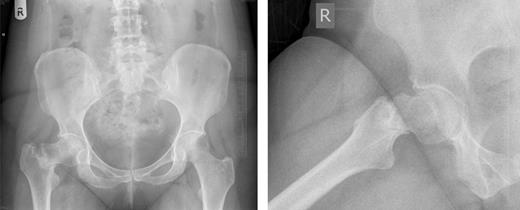 Pelvic and right hip radiograph's taken 5 months after the onset of symptoms demonstrating the fracture neck of femur.