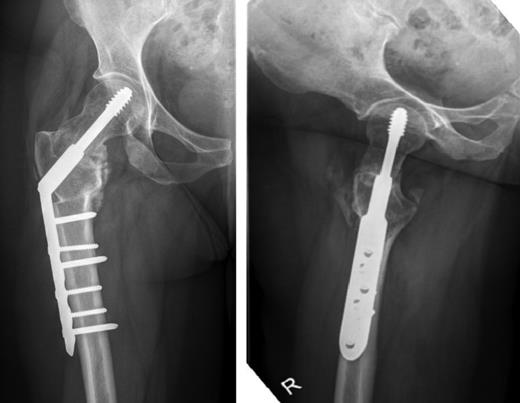 Anterior-posterior and lateral radiographs taken 6 months postoperatively demonstrating union of the fracture and osteotomy site.