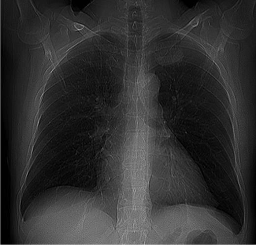 Chest X-ray.