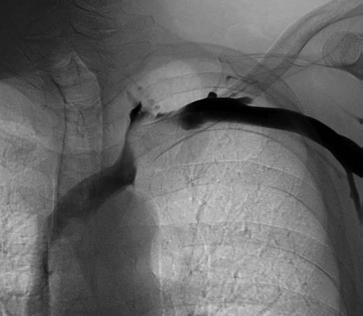 Phlebography reveals a compression of the left subclavian vein.