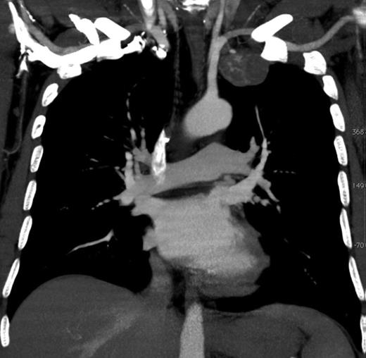MRI scan of the thorax shows a tumour at the left pleural cupula.