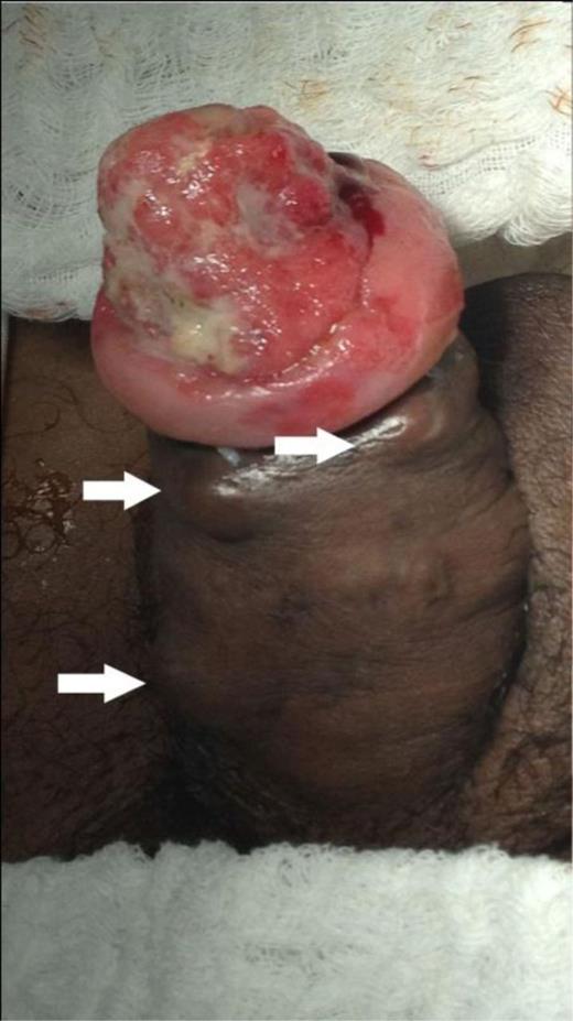 Penile neoplasm in glans, coronal sulcus and foreskin. The white arrows indicate the ‘Bouglou’ penile nodules.