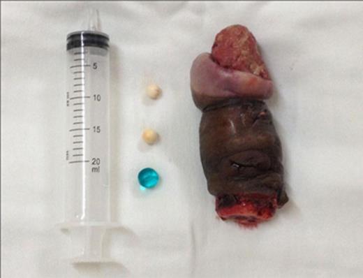 ‘Bouglou’ penile nodules. The difference in their shapes and materials can be noted. On the right is the surgical product of total penile amputation.