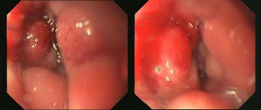 Endoscopic images of the duodenal bulb.