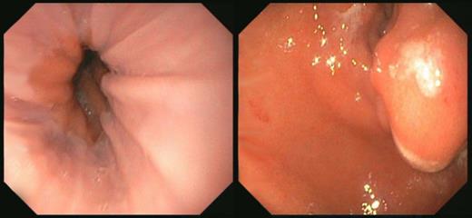 Endoscopic images of the lower oesophagus (left) and prepyloric stenosis (right).