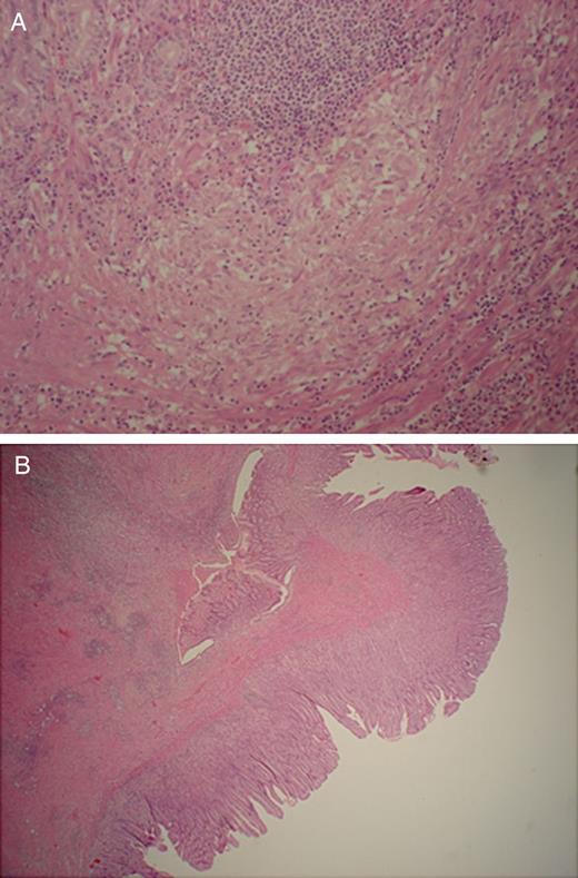 (A) Epithelioid granuloma away from sites of ulceration (×20 H&E). (B) Antral stomach with fissuring ulceration with Crohn's-like lymphoid aggregate formation (×10 H&E).