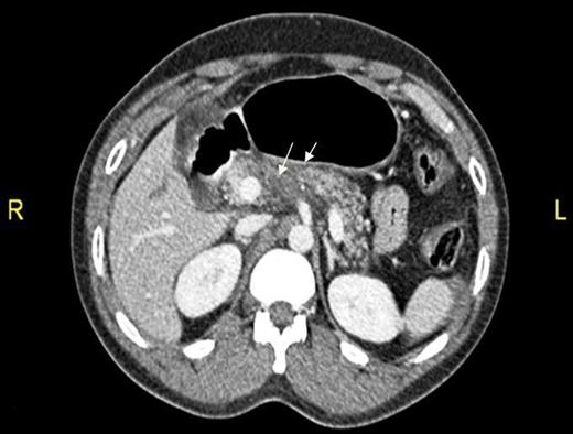 CT abdomen showing two hepatic lacerations in addition to minimal subhepatic and left subdiaphragmatic free fluid.