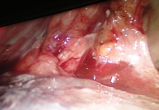 The intraoperative extension of the pancreatic necrosis that involves the entire gland.
