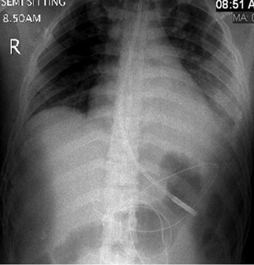 Chest X-ray demonstrated a large left-sided pleural effusion.