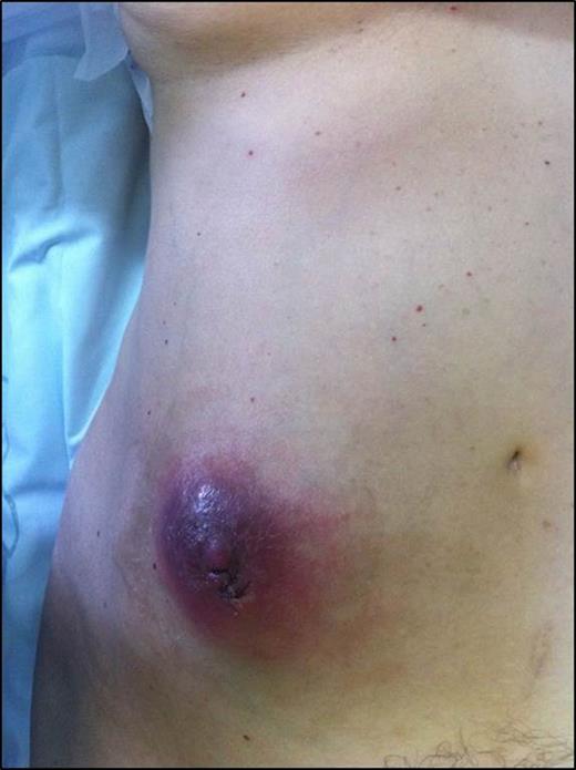 Inflamed lump on the right lateral abdominal wall initially considered as cutaneous abcess.
