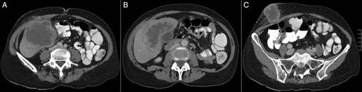 (A–C) A CT scan revealing a large hepatic mass invading the abdominal wall.