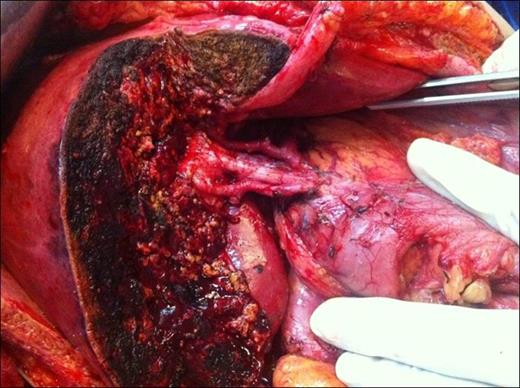 Intraoperative view after resection of segments 4B, 5 and 6 of the liver along with a regional hepatoduodenal ligament lymphadenectomy.