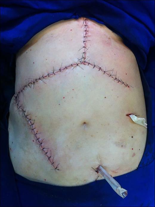 Final aspect of the abdominal wall.