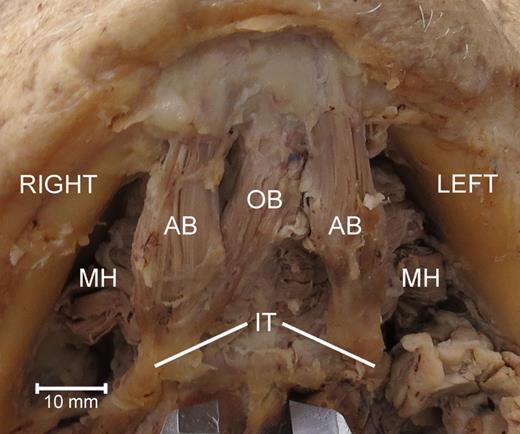 Inferior view of the variant digastric musculature demonstrating an oblique digastric belly variant crossing from the left digastric fossa of the mandible to the right intermediate tendon of the right digastric muscle. AB, anterior belly of the digastric muscle; OB, oblique belly of the anterior digastric muscle; MH, mylohyoid muscle; IT, intermediate tendon of the digastric muscle.